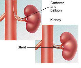 Renal Vein Thrombosis